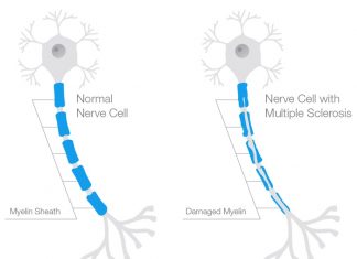 New Age Therapeutics Offer Hope to Patients of Multiple Sclerosis